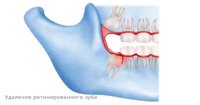 Зубной камень, налет или кариес: в чем отличия? | Стоматология Бескудниково