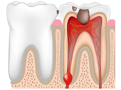 Зубной штифт – что это, виды, плюсы и минусы | Блог | Стоматология «Дент  Тайм»