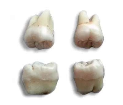 Воспаление корня зуба: симптомы, лечение, профилактика - полезная  информация от врачей стоматологической клиники доктора Фролова