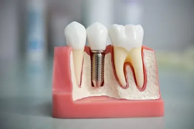 Коронка на зуб: цена в Москве на установку передней зубной коронки и  протезирование в клинике стоматологии