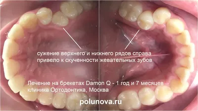 Выравнивание зубов без брекетов у взрослых: цена на исправление прикуса от  4 000 руб - Estetica