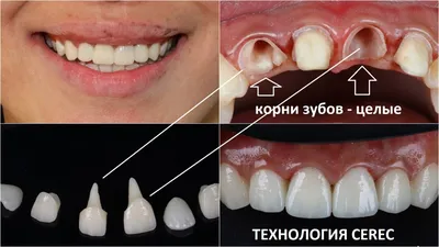 Строение зуба. Доступная стоматология и имплантация