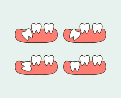 Когда корень зуба удалять, а когда восстанавливать зуб? - Немецкий  Имплантологический Центр, Москва