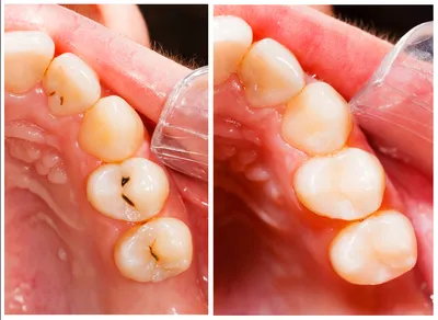 Сломался передний зуб под корень — что делать?