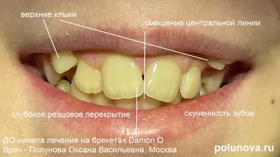 зубы мудрости — IMPLANT-IN.COM — дентальная имплантация. естественно.