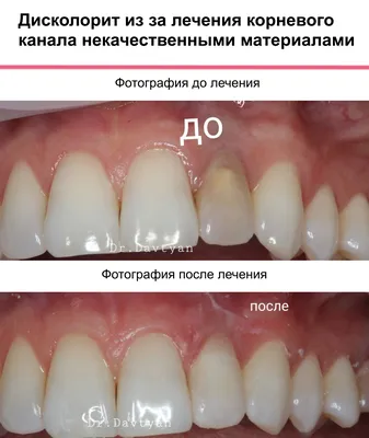 Как вылечить зубы взрослым и ребенку: как лечить зуб мудрости, молочный зуб