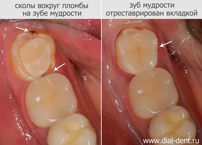 Удаление зуба мудрости