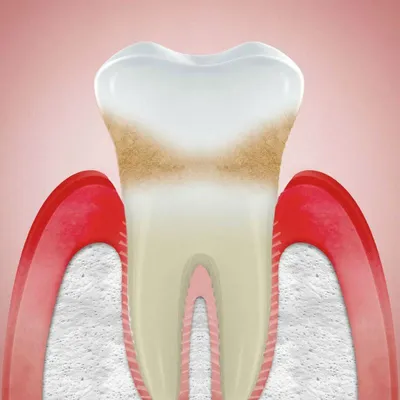 Нужно ли удалять зубы мудрости - показания, противопоказания к удалению  зубов мудрости, как проводится операция