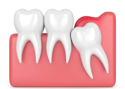 Удаление зубов мудрости. Показания, особенности, осложнения